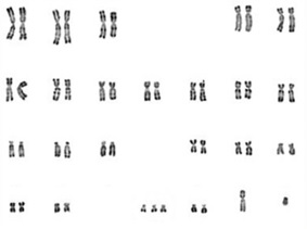 Caryotype d'un trisomie